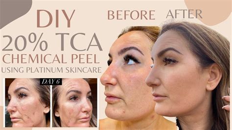 tca peel reviews|TCA Peel: A Complete Guide to Benefits & Uses – Perfect Image.